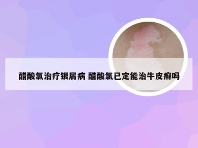 醋酸氯治疗银屑病 醋酸氯已定能治牛皮癣吗