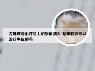 龙珠软膏治疗脸上的银屑病么 龙珠软膏可以治疗牛皮癣吗