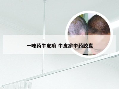 一味药牛皮癣 牛皮癣中药胶囊