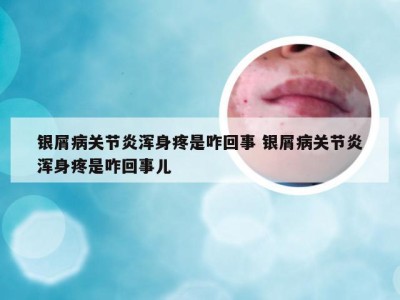 银屑病关节炎浑身疼是咋回事 银屑病关节炎浑身疼是咋回事儿