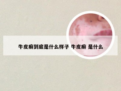 牛皮癣到底是什么样子 牛皮癣 是什么