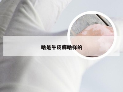 啥是牛皮癣啥样的