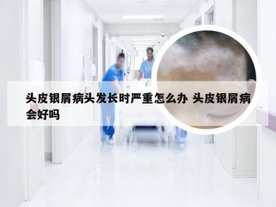 头皮银屑病头发长时严重怎么办 头皮银屑病会好吗