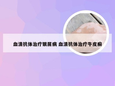 血清抗体治疗银屑病 血清抗体治疗牛皮癣