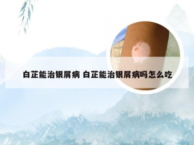 白芷能治银屑病 白芷能治银屑病吗怎么吃