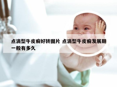点滴型牛皮癣好转图片 点滴型牛皮癣发展期一般有多久