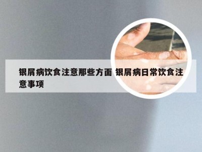 银屑病饮食注意那些方面 银屑病日常饮食注意事项