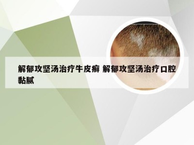 解郁攻坚汤治疗牛皮癣 解郁攻坚汤治疗口腔黏腻