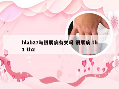 hlab27与银屑病有关吗 银屑病 th1 th2