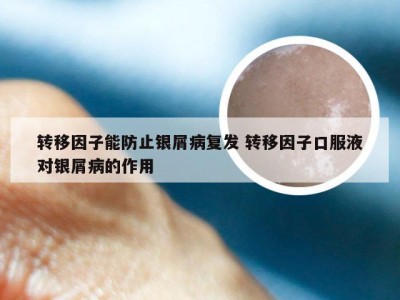 转移因子能防止银屑病复发 转移因子口服液对银屑病的作用