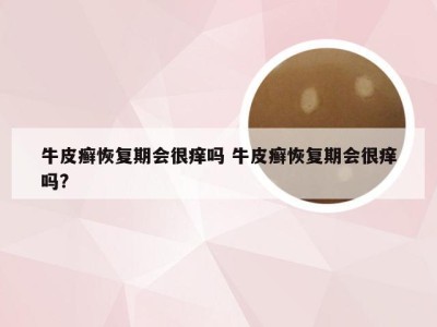 牛皮癣恢复期会很痒吗 牛皮癣恢复期会很痒吗?