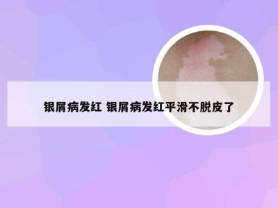 银屑病发红 银屑病发红平滑不脱皮了
