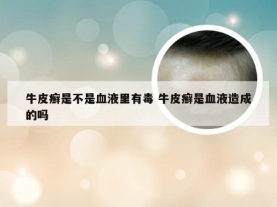 牛皮癣是不是血液里有毒 牛皮癣是血液造成的吗