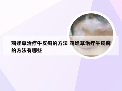 鸡娃草治疗牛皮癣的方法 鸡娃草治疗牛皮癣的方法有哪些