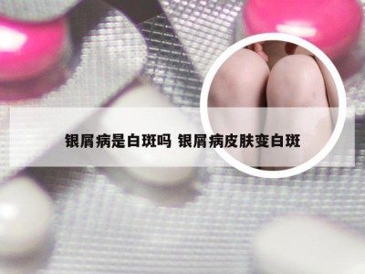 银屑病是白斑吗 银屑病皮肤变白斑