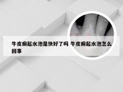 牛皮癣起水泡是快好了吗 牛皮癣起水泡怎么回事