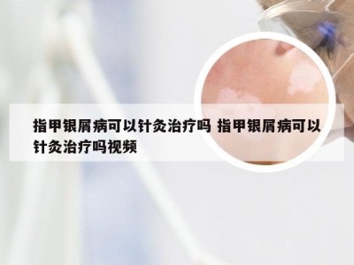 指甲银屑病可以针灸治疗吗 指甲银屑病可以针灸治疗吗视频