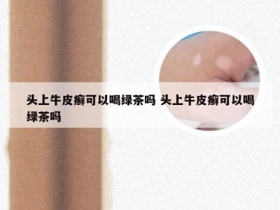 头上牛皮癣可以喝绿茶吗 头上牛皮癣可以喝绿茶吗