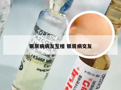 银屑病病友互相 银屑病交友