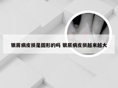 银屑病皮损是圆形的吗 银屑病皮损越来越大