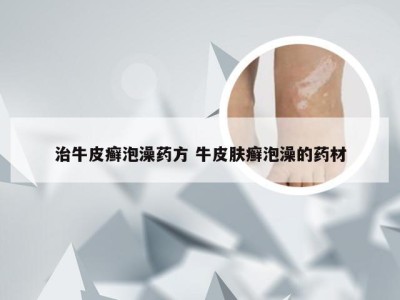 治牛皮癣泡澡药方 牛皮肤癣泡澡的药材