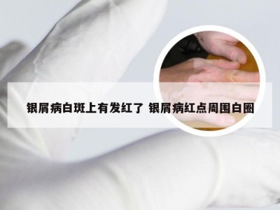 银屑病白斑上有发红了 银屑病红点周围白圈