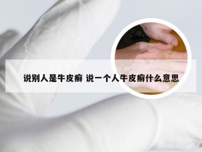 说别人是牛皮癣 说一个人牛皮癣什么意思