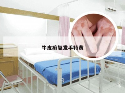 牛皮癣复发手特黄