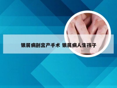 银屑病剖宫产手术 银屑病人生孩子
