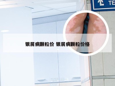 银屑病颗粒价 银屑病颗粒价格