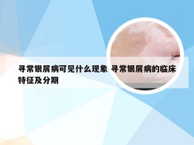 寻常银屑病可见什么现象 寻常银屑病的临床特征及分期