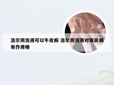 洁尔阴洗液可以牛皮癣 洁尔阴洗液对银屑病有作用哪