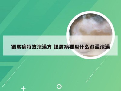 银屑病特效泡澡方 银屑病要用什么泡澡泡澡
