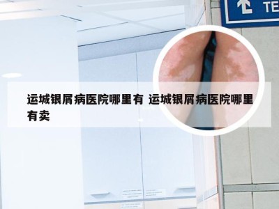 运城银屑病医院哪里有 运城银屑病医院哪里有卖