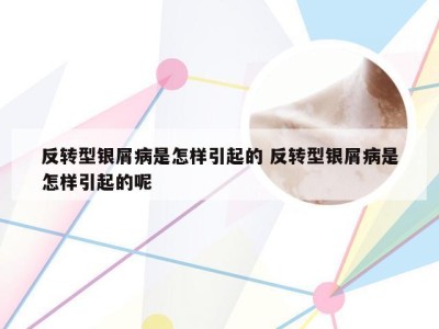 反转型银屑病是怎样引起的 反转型银屑病是怎样引起的呢