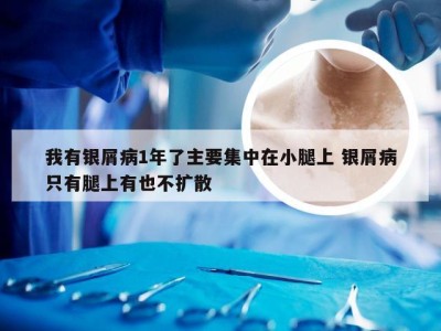 我有银屑病1年了主要集中在小腿上 银屑病只有腿上有也不扩散