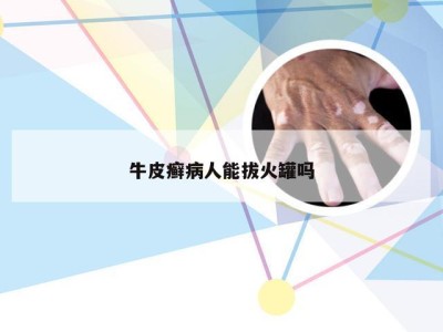 牛皮癣病人能拔火罐吗