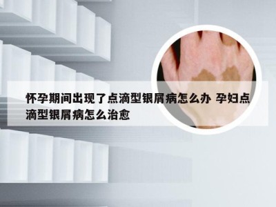怀孕期间出现了点滴型银屑病怎么办 孕妇点滴型银屑病怎么治愈