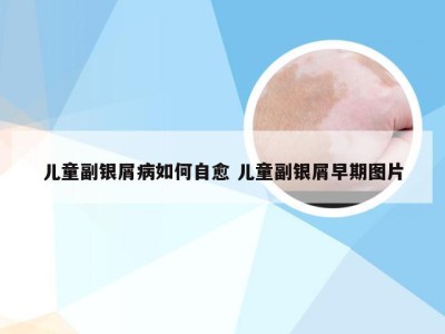 儿童副银屑病如何自愈 儿童副银屑早期图片
