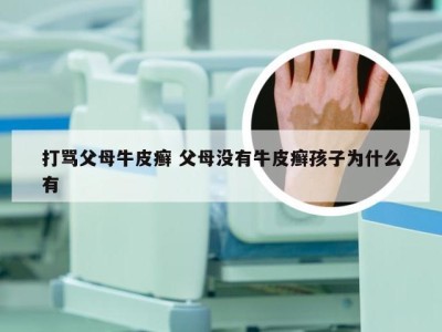 打骂父母牛皮癣 父母没有牛皮癣孩子为什么有