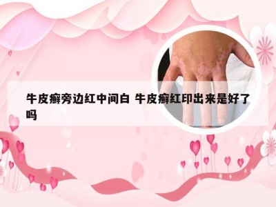 牛皮癣旁边红中间白 牛皮癣红印出来是好了吗