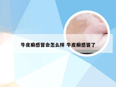 牛皮癣感冒会怎么样 牛皮癣感冒了