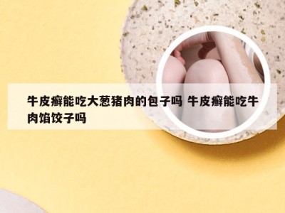 牛皮癣能吃大葱猪肉的包子吗 牛皮癣能吃牛肉馅饺子吗