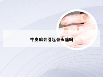 牛皮癣会引起骨头痛吗