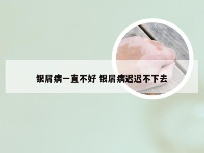银屑病一直不好 银屑病迟迟不下去