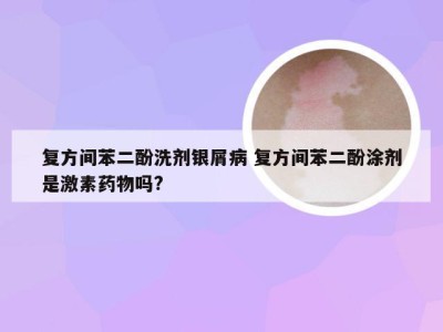 复方间苯二酚洗剂银屑病 复方间苯二酚涂剂是激素药物吗?