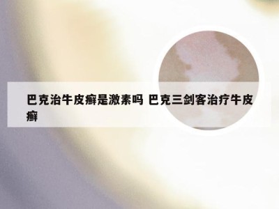 巴克治牛皮癣是激素吗 巴克三剑客治疗牛皮癣
