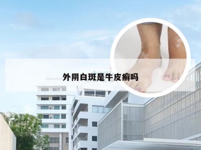 外阴白斑是牛皮癣吗