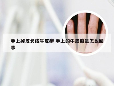手上掉皮长成牛皮癣 手上的牛皮癣是怎么回事