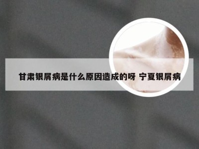甘肃银屑病是什么原因造成的呀 宁夏银屑病